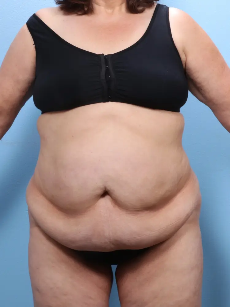 Tummy Tuck - Case 1867 - Before