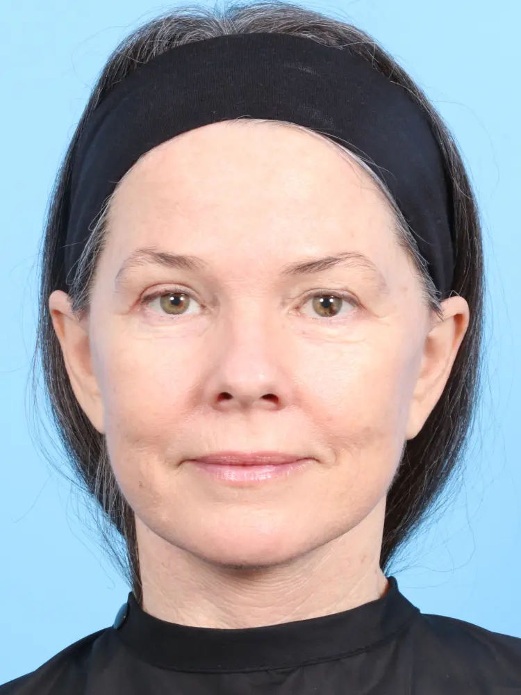 Eyelid Surgery - Case 1870 - After