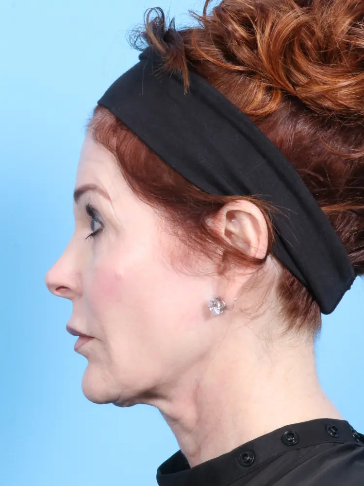 Rhinoplasty - Case 1877 - After