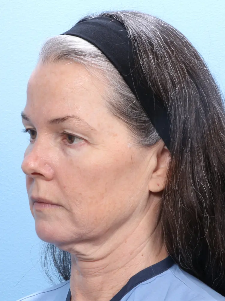 Eyelid Surgery Patient Photo - Case 1870 - before view-1