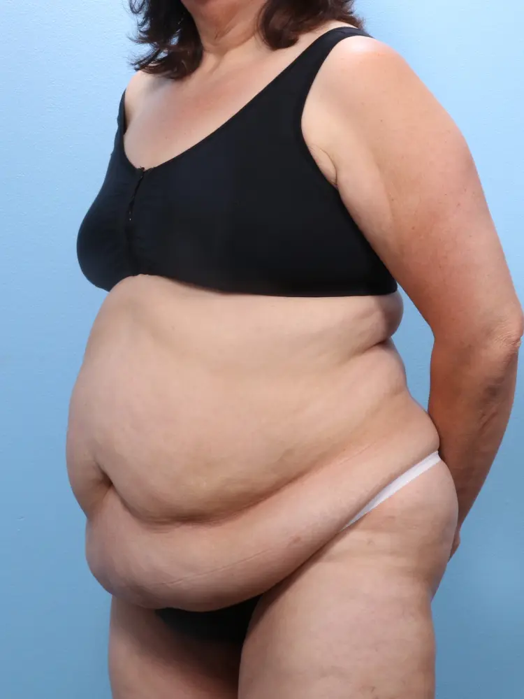 Tummy Tuck Patient Photo - Case 1867 - before view-1