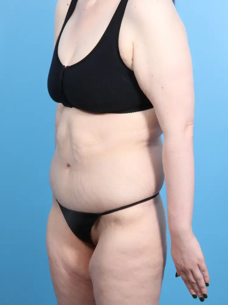 Body Lift Patient Photo - Case 1869 - after view-1