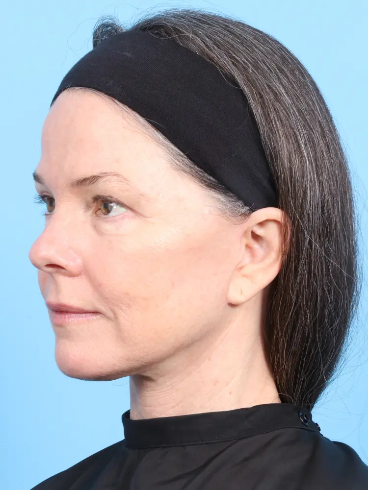 Eyelid Surgery Patient Photo - Case 1870 - after view-1