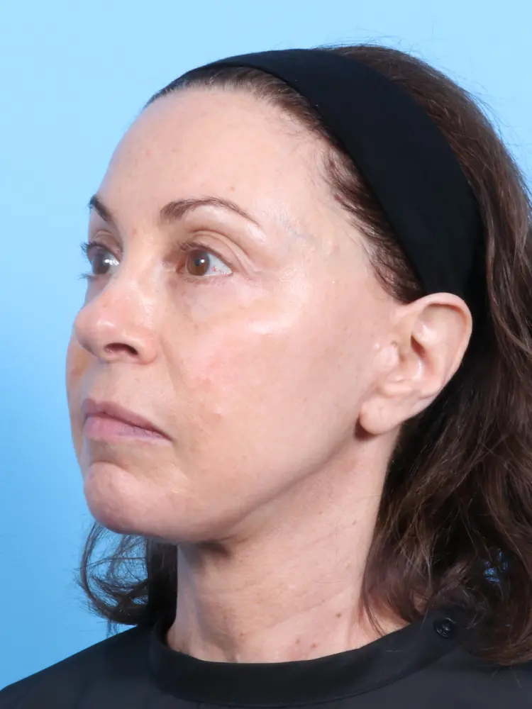Facelift / Neck Lift Patient Photo - Case 1879 - after view-1