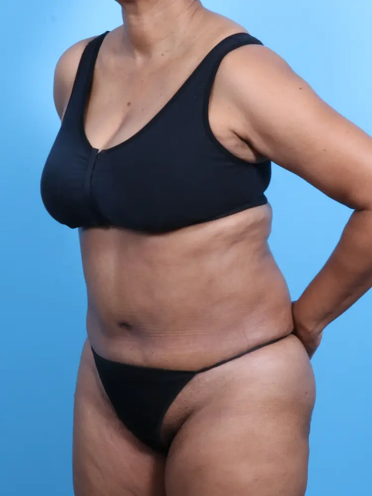 Tummy Tuck Patient Photo - Case 1862 - after view-1