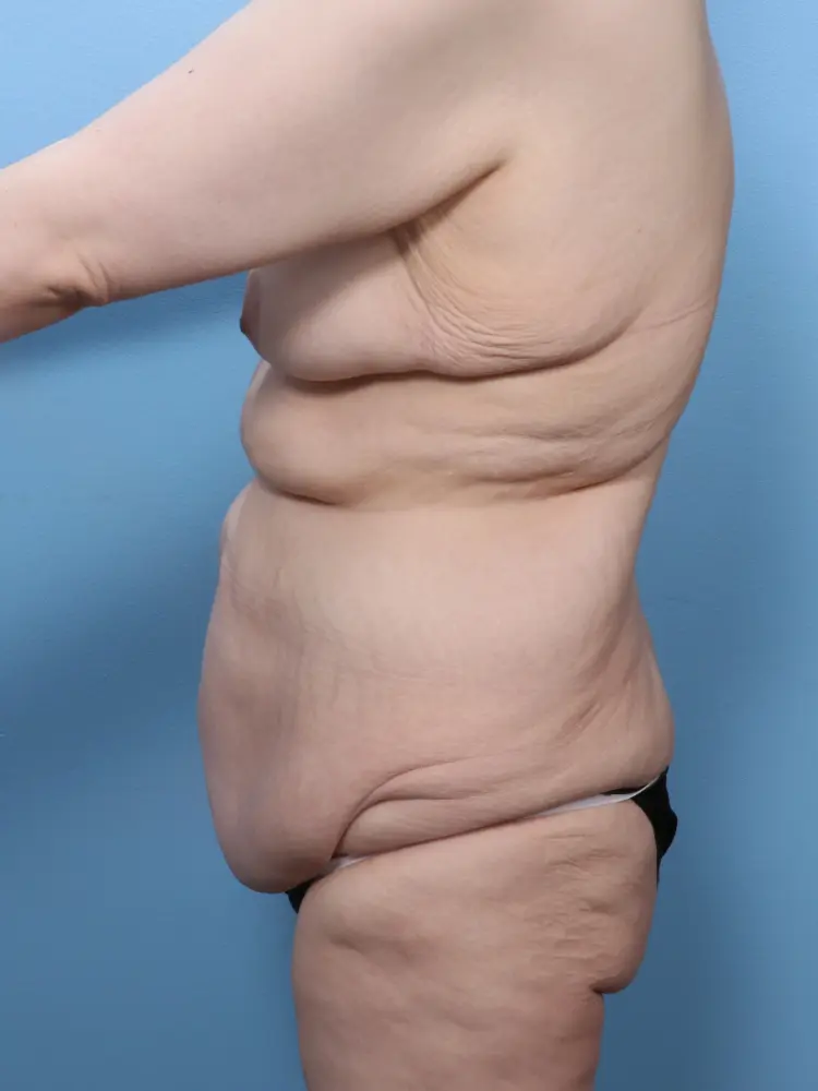 Body Lift Patient Photo - Case 1869 - before view-2