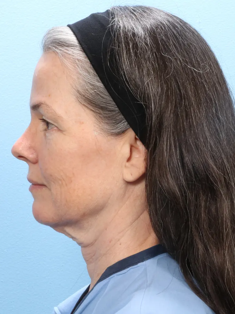 Eyelid Surgery Patient Photo - Case 1870 - before view-2