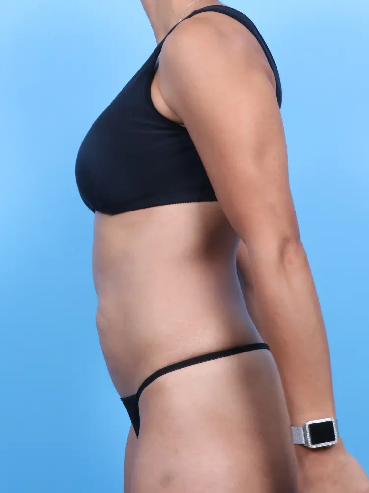 Tummy Tuck Patient Photo - Case 1888 - before view-2