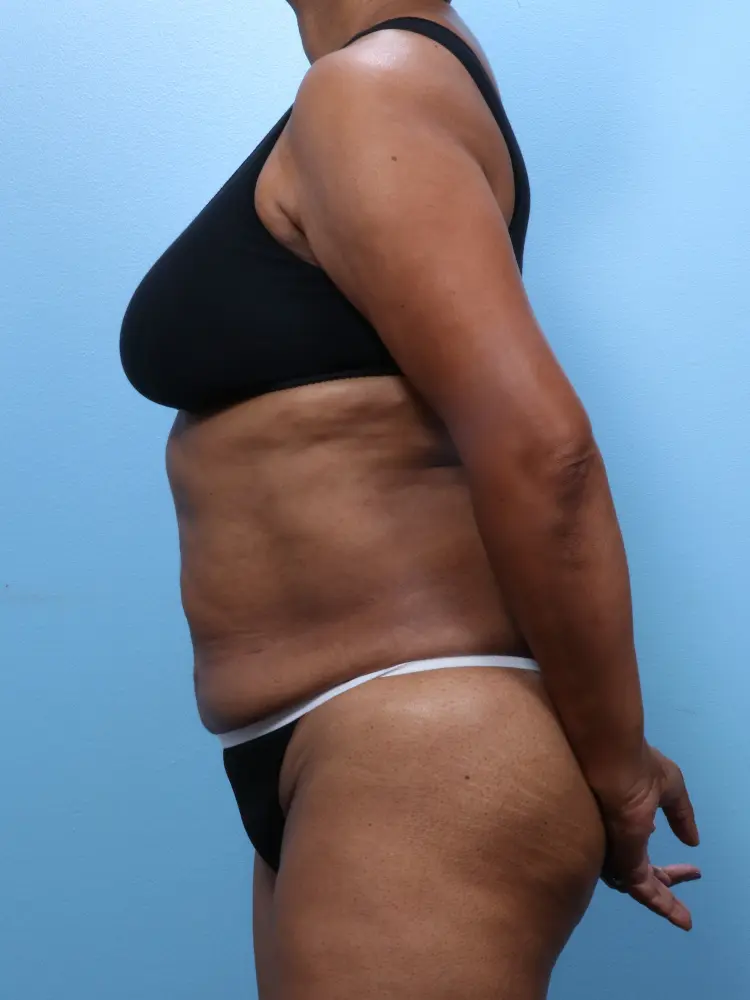 Tummy Tuck Patient Photo - Case 1862 - before view-2