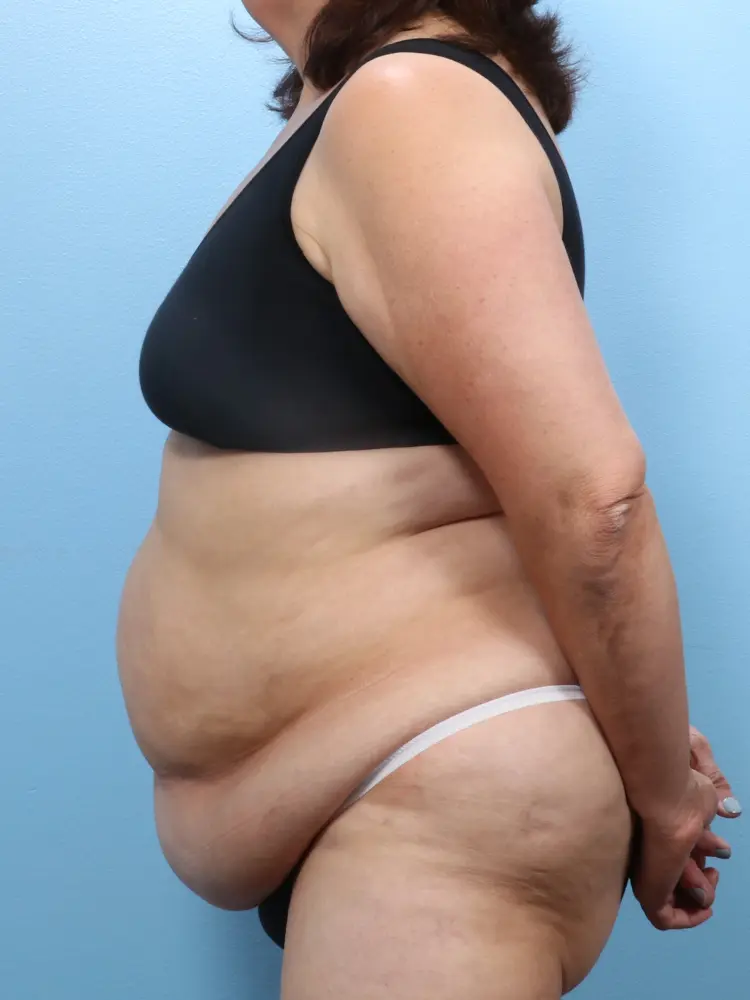 Tummy Tuck Patient Photo - Case 1867 - before view-2