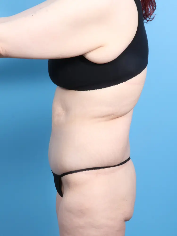 Body Lift Patient Photo - Case 1869 - after view-2