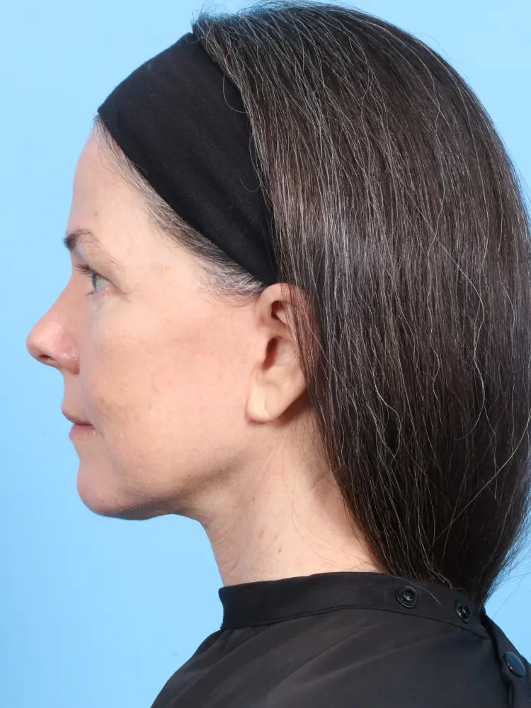 Eyelid Surgery Patient Photo - Case 1870 - after view-2