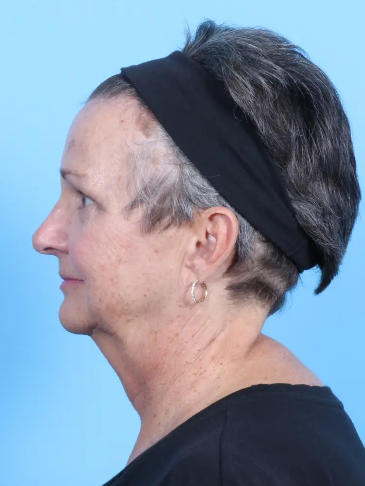 Brow Lift Patient Photo - Case 1872 - after view-2