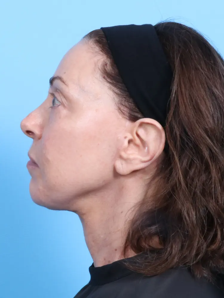 Facelift / Neck Lift Patient Photo - Case 1879 - after view-2