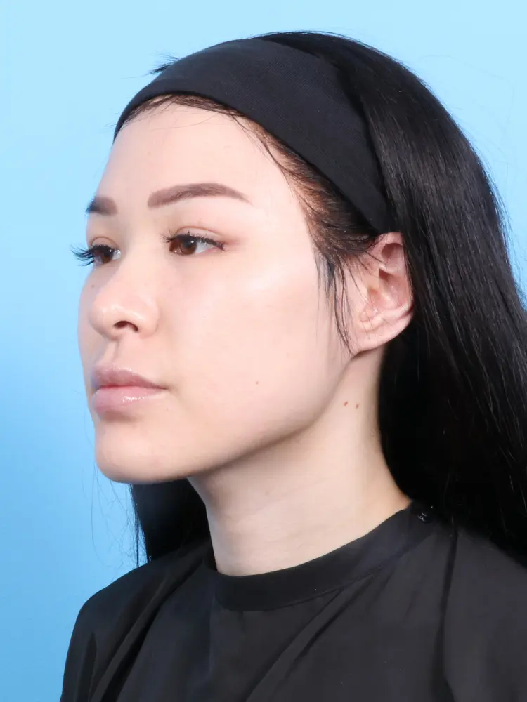 Rhinoplasty Patient Photo - Case 1881 - after view-2