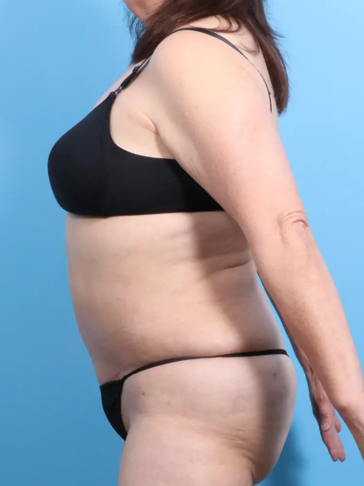 Tummy Tuck Patient Photo - Case 1867 - after view-2