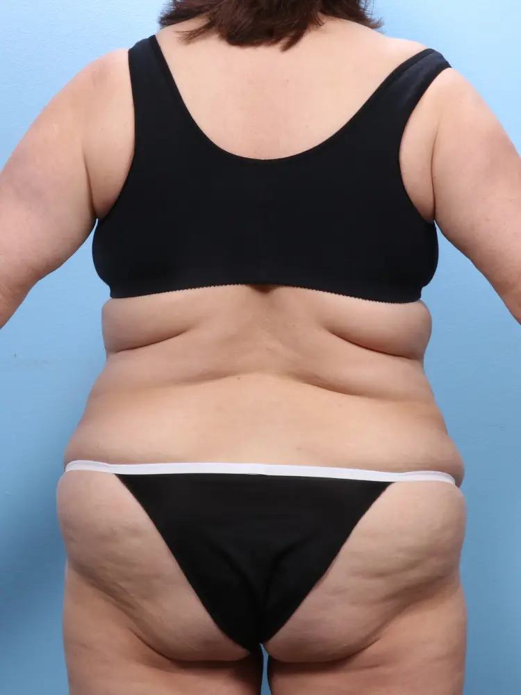 Tummy Tuck Patient Photo - Case 1867 - before view-3