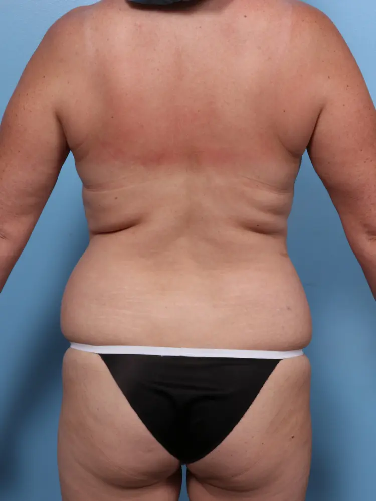 Breast Lift/Reduction w/o Implants Patient Photo - Case 1873 - before view-3