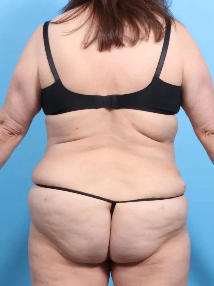 Tummy Tuck Patient Photo - Case 1867 - after view-3
