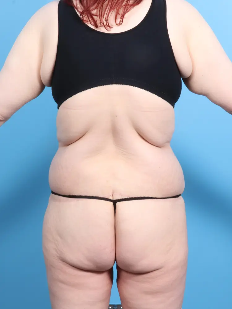 Body Lift Patient Photo - Case 1869 - after view-3