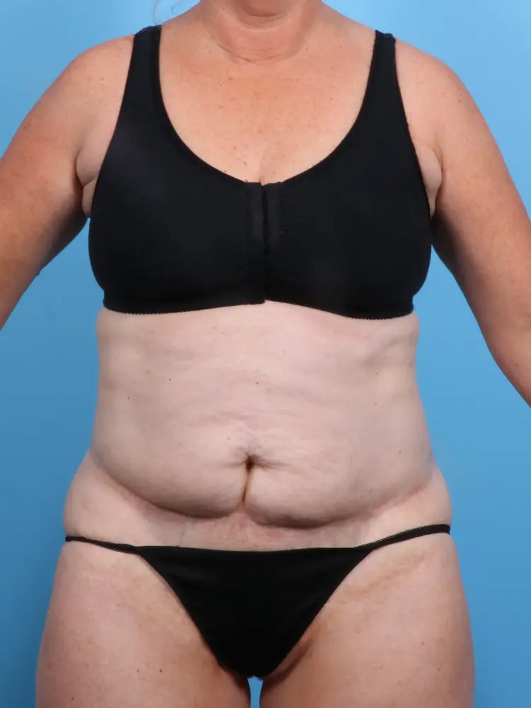 Tummy Tuck - Case 1906 - Before