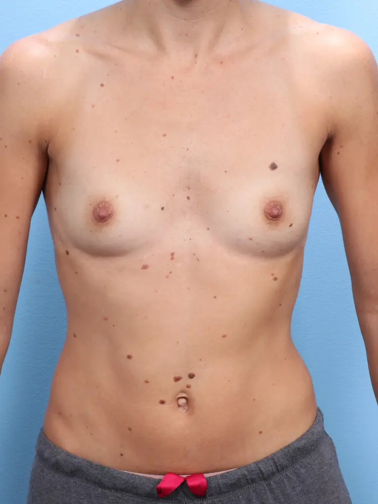 Breast Augmentation - Case 1902 - Before