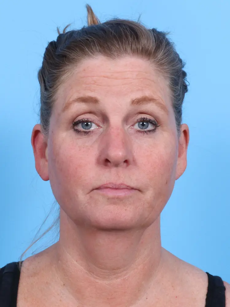Facelift / Neck Lift - Case 1904 - Before