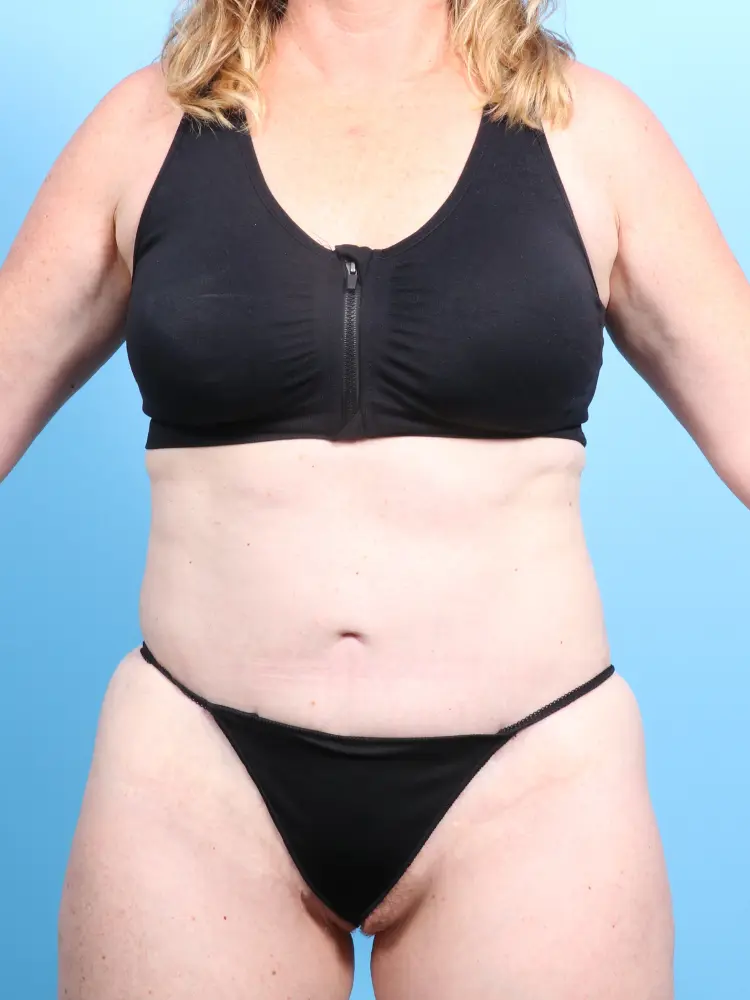 Tummy Tuck - Case 1906 - After