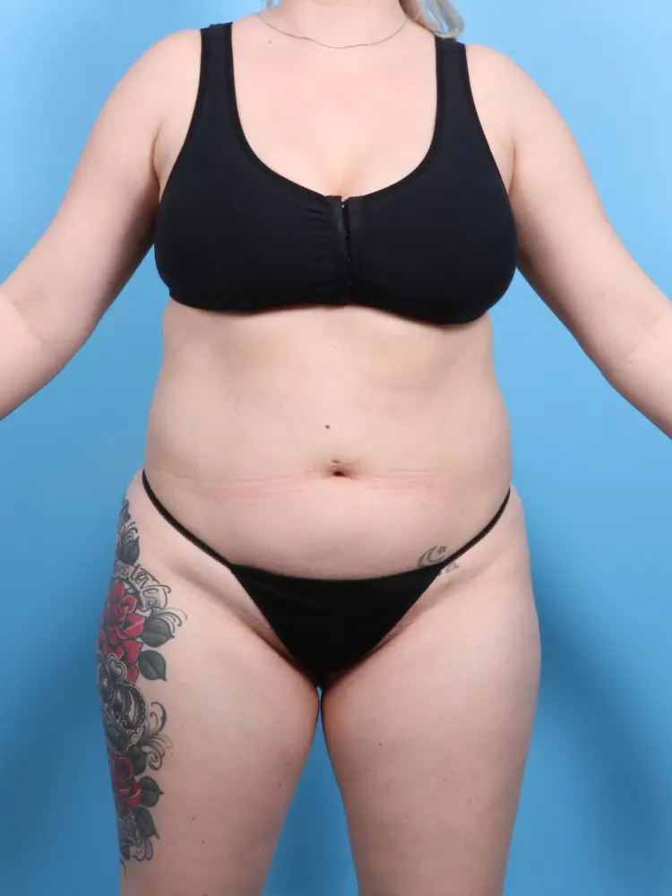 Brazilian Butt Lift Patient Photo - Case 1896 - before view-1