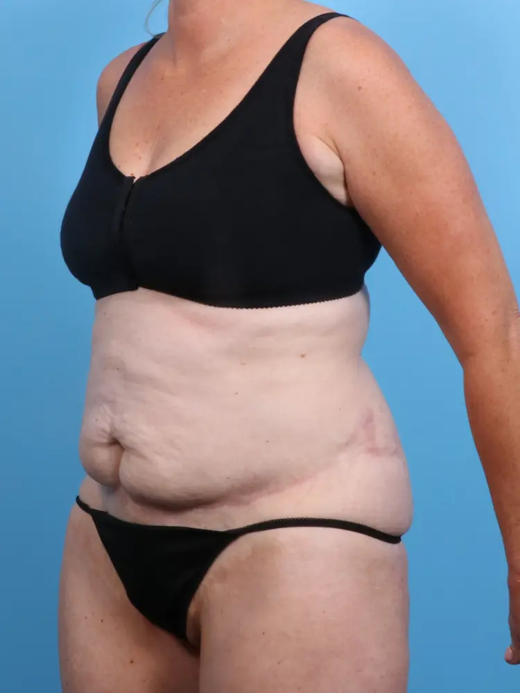 Tummy Tuck Patient Photo - Case 1906 - before view-1
