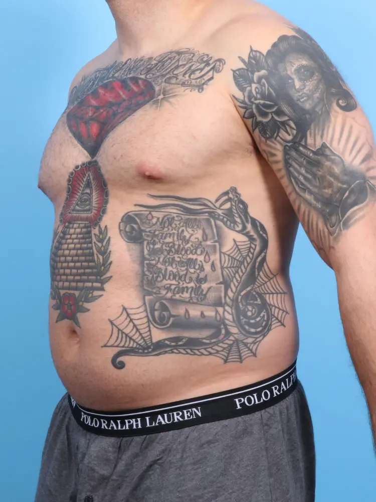 Male Liposuction Patient Photo - Case 1899 - before view-1