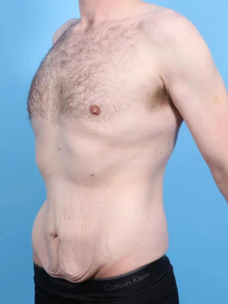 Male Body Lift Patient Photo - Case 1900 - before view-1