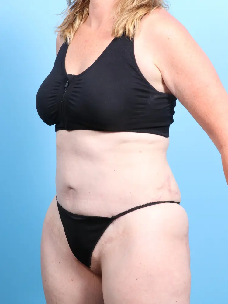Tummy Tuck Patient Photo - Case 1906 - after view-1
