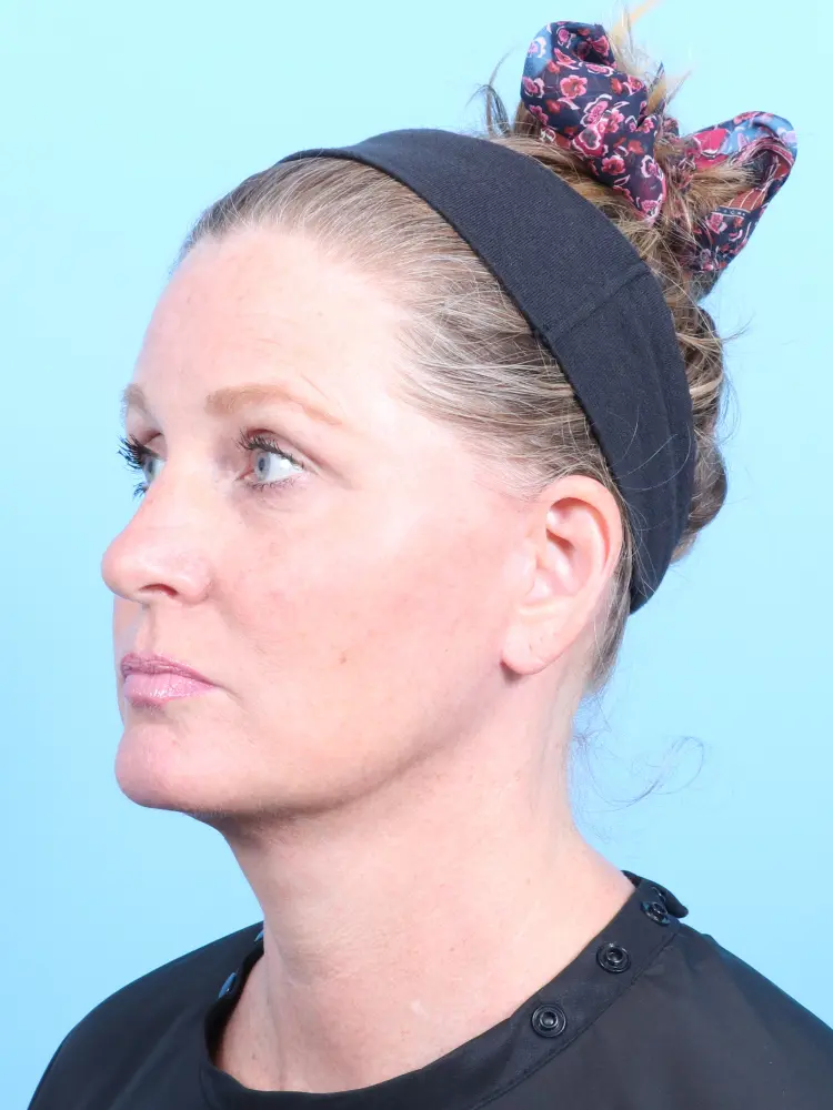 Facelift / Neck Lift Patient Photo - Case 1904 - after view-1