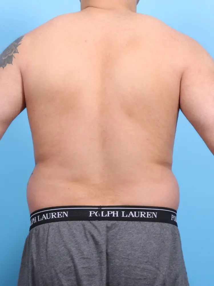 Male Liposuction Patient Photo - Case 1899 - before view-3