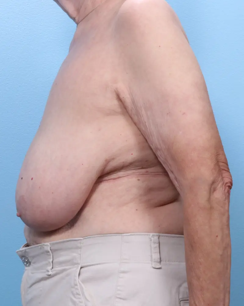 Breast Lift/Reduction w/o Implants Patient Photo - Case 1903 - before view-2