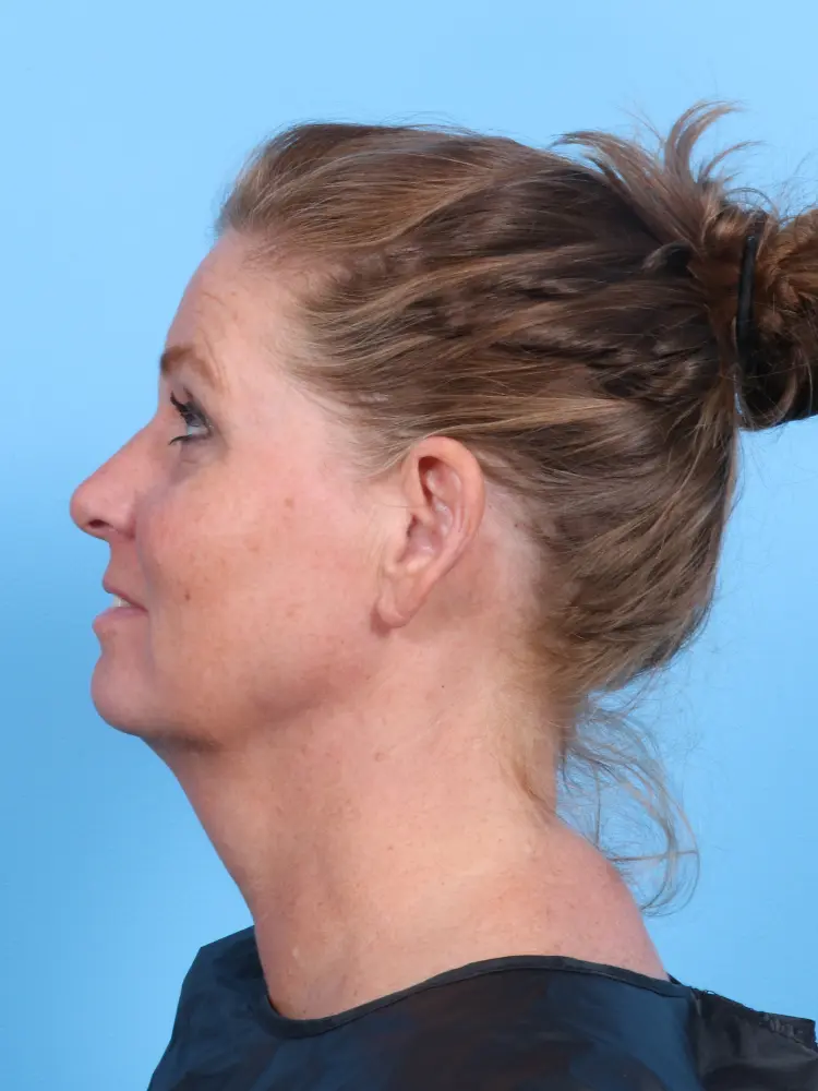 Facelift / Neck Lift Patient Photo - Case 1904 - before view-2