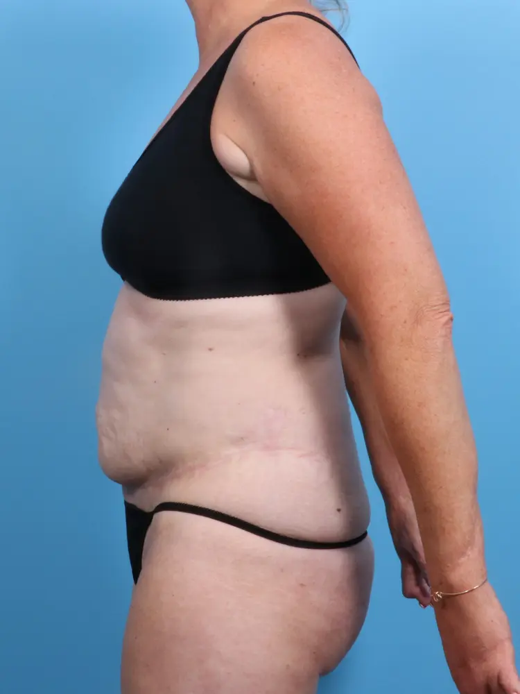 Tummy Tuck Patient Photo - Case 1906 - before view-2