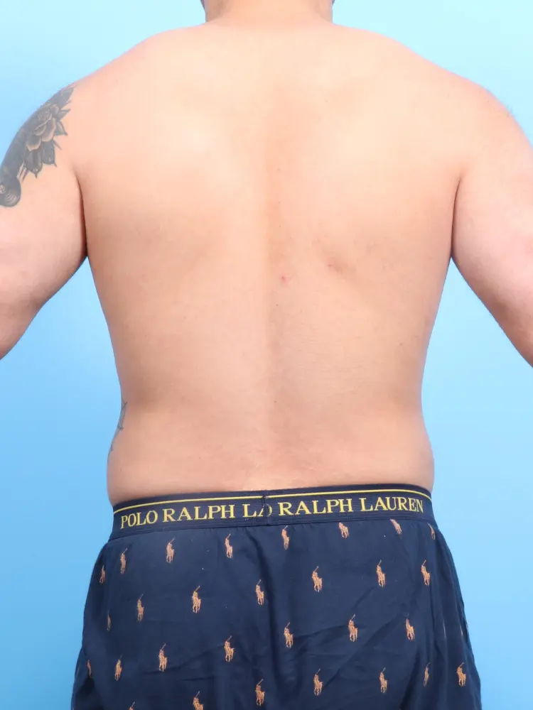 Male Liposuction Patient Photo - Case 1899 - after view-3