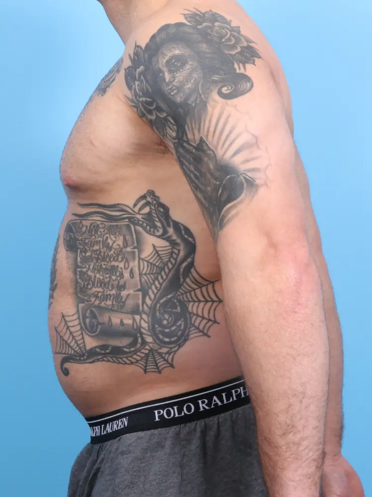 Male Liposuction Patient Photo - Case 1899 - before view-2