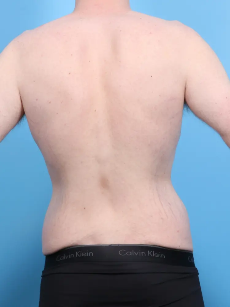 Male Body Lift Patient Photo - Case 1900 - before view-3