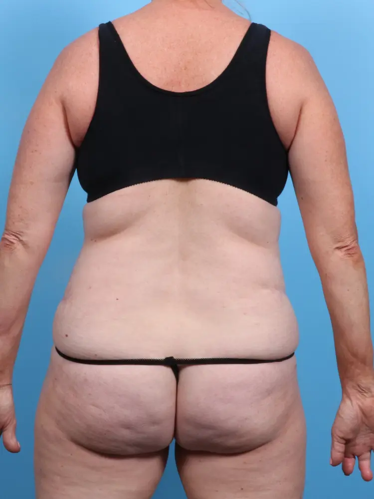 Tummy Tuck Patient Photo - Case 1906 - before view-3