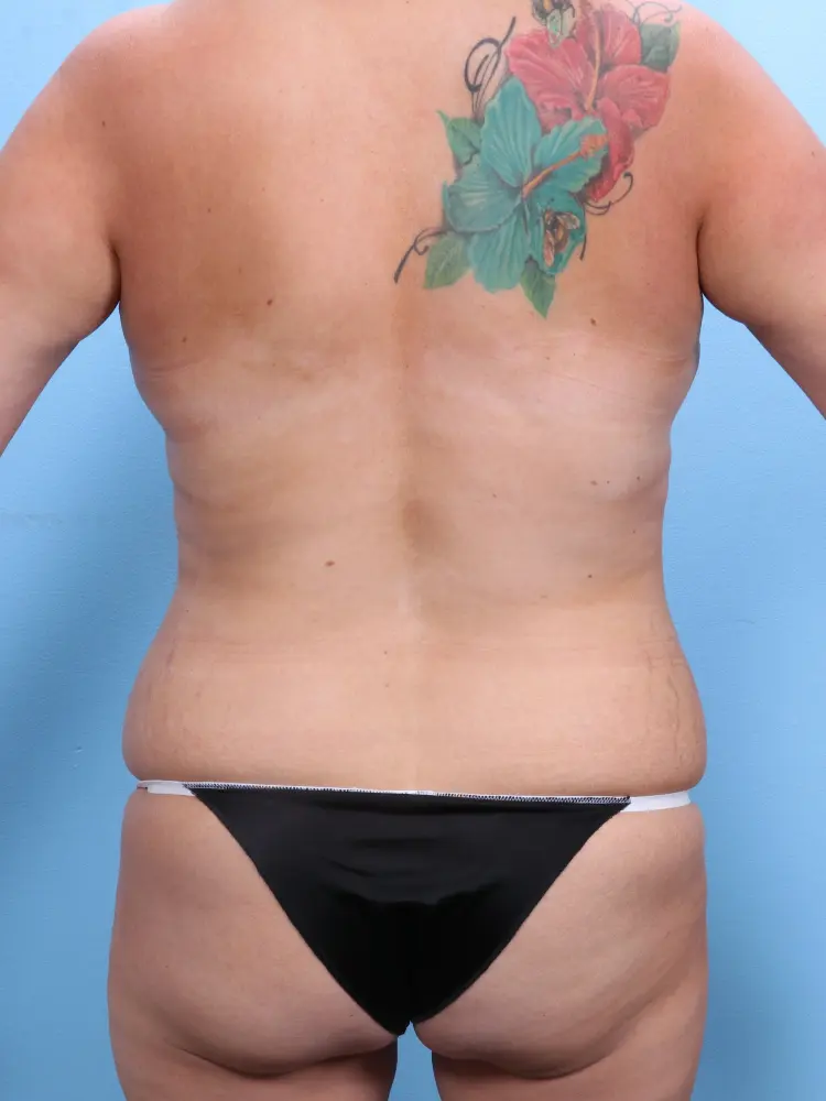 Mommy Makeover Patient Photo - Case 1907 - before view-3