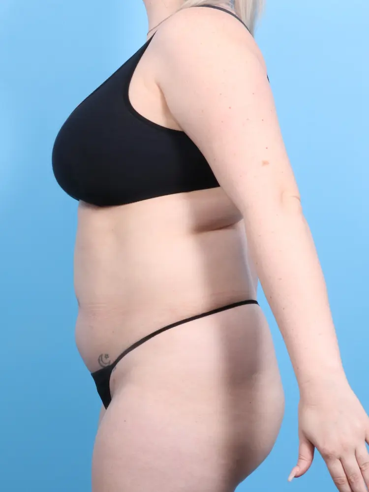 Brazilian Butt Lift Patient Photo - Case 1896 - before view-3