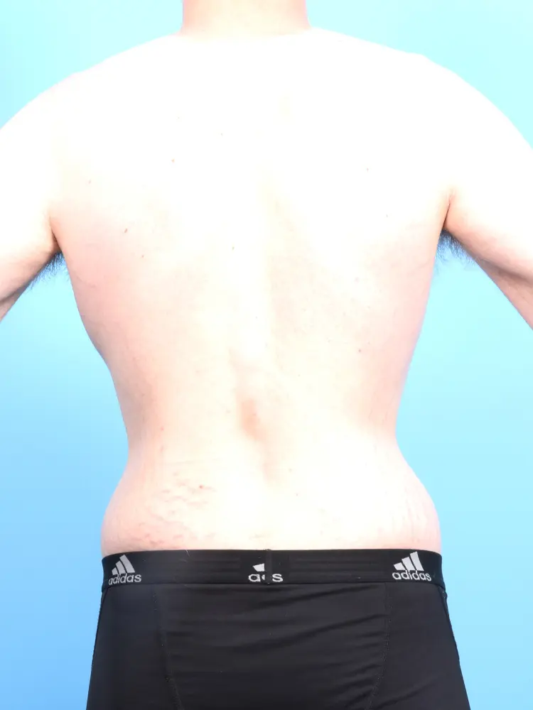 Male Body Lift Patient Photo - Case 1900 - after view-3