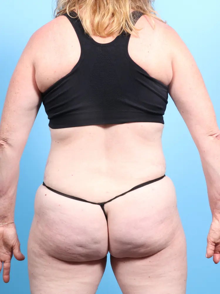 Tummy Tuck Patient Photo - Case 1906 - after view-3