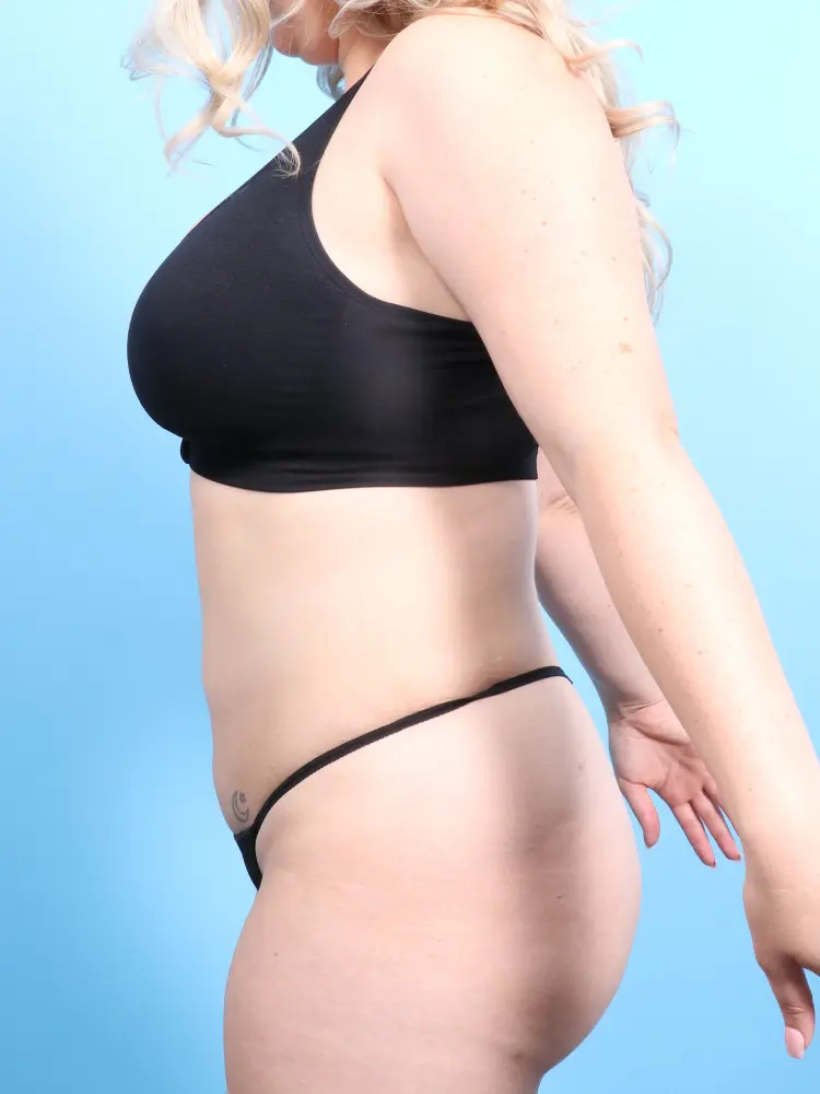 Brazilian Butt Lift Patient Photo - Case 1896 - after view-3