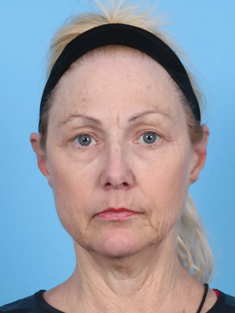 Eyelid Surgery - Case 1920 - Before