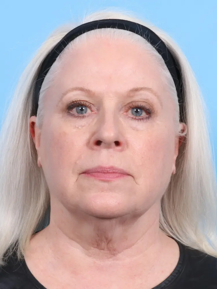 Eyelid Surgery - Case 1924 - Before