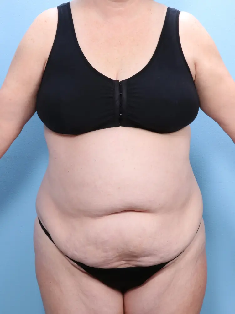 Tummy Tuck - Case 1912 - Before